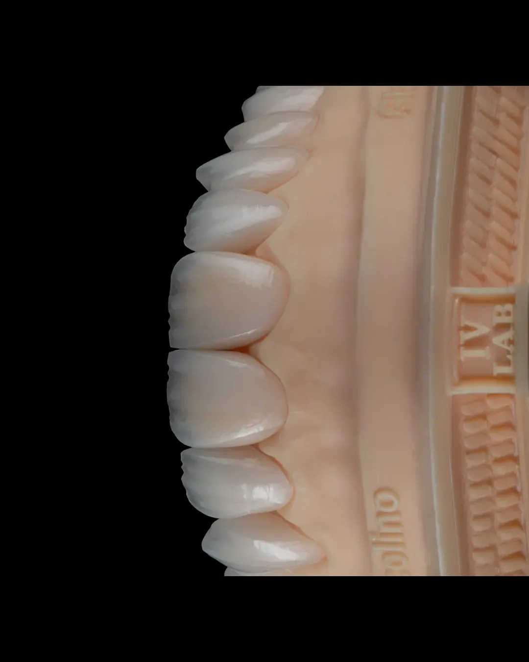 Vista lateral de lentes de contato sobre modelo odontológico